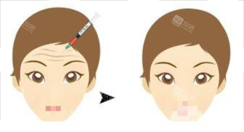打针除皱前后对比图 打针除皱前后对比图