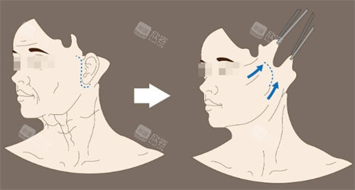 拉皮手术前后对比图 拉皮手术前后对比图