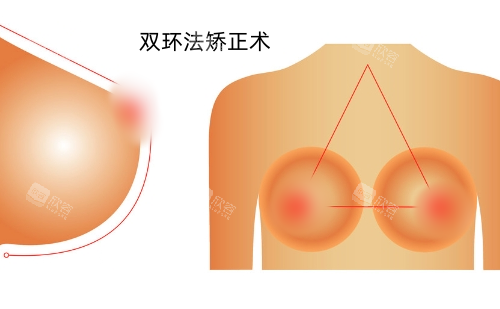 双环法乳房下垂矫正展示图 双环法乳房下垂矫正展示图