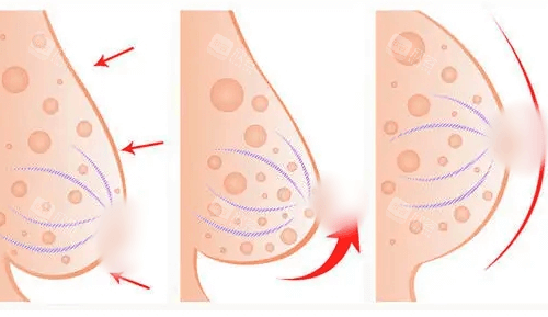 乳房塑形悬吊矫正术 乳房塑形悬吊矫正术