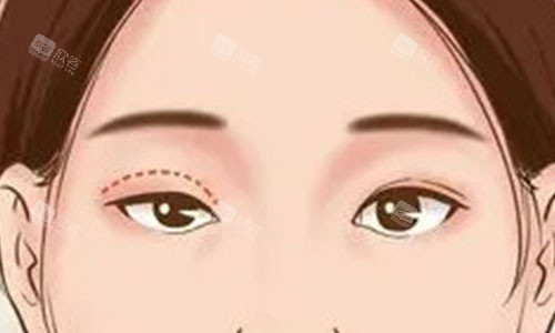 单眼皮