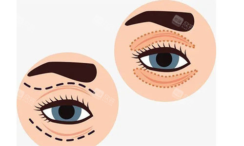 埋线和全切双眼皮哪个比较好？双眼皮常见问题大解密