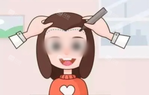调整发际线动画展示图 调整发际线动画展示图