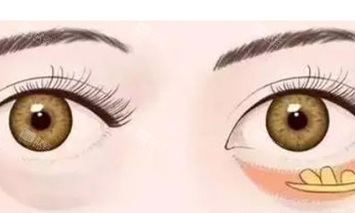 眼袋手术过程动画图 眼袋手术过程动画图