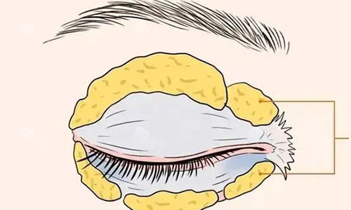 眼袋脂肪的动画图 眼袋脂肪的动画图