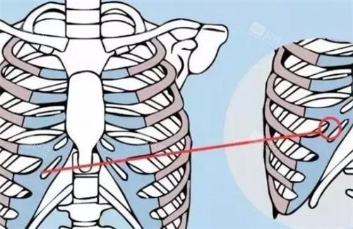 自体软骨隆鼻优劣分析：肋骨、耳软骨、鼻中隔软骨怎么选择？