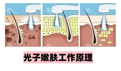 光子嫩肤工作原理图 光子嫩肤工作原理图