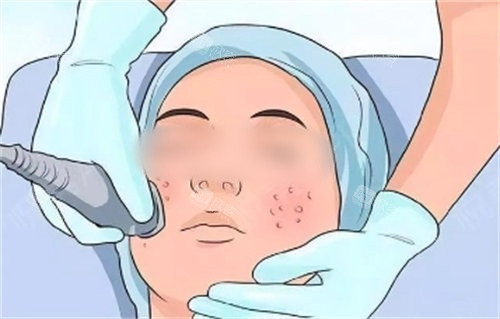 光子嫩肤动画操作图 光子嫩肤动画操作图