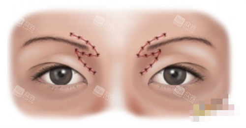 提眉部位切口画线展示图