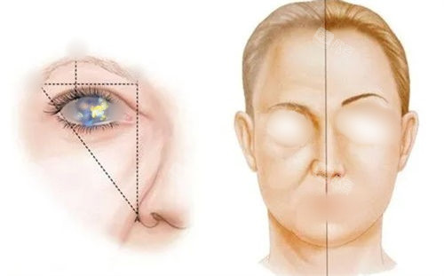提眉手术前后对比图和局部点位展示图