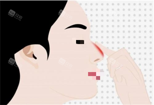 隆鼻前示意图 隆鼻前示意图