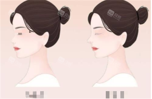 隆鼻前后对比图 隆鼻前后对比图