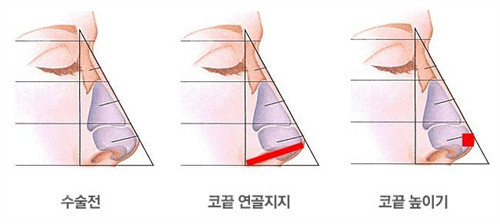 隆鼻手术前后方法示例图 隆鼻手术前后方法示例图
