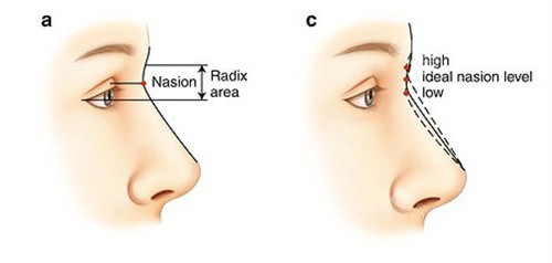 膨体假体隆鼻：打造优质鼻型，消肿秘籍揭秘！