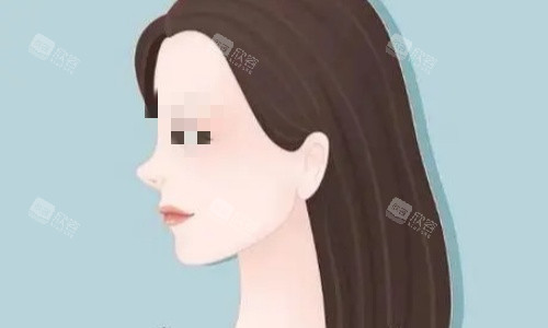 硅胶隆鼻术后示意图 硅胶隆鼻术后示意图