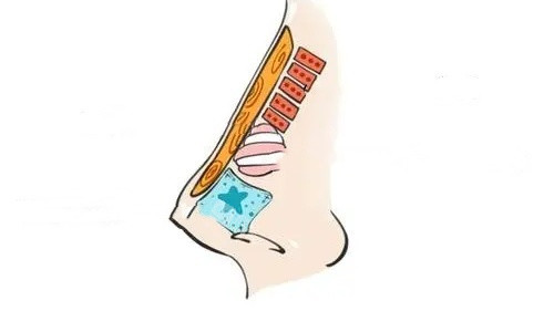硅胶隆鼻结构示意图 硅胶隆鼻结构示意图