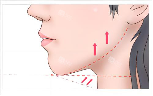 下巴提升术后示例图