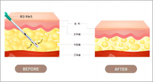 抽脂脂肪前后对比图 抽脂脂肪前后对比图